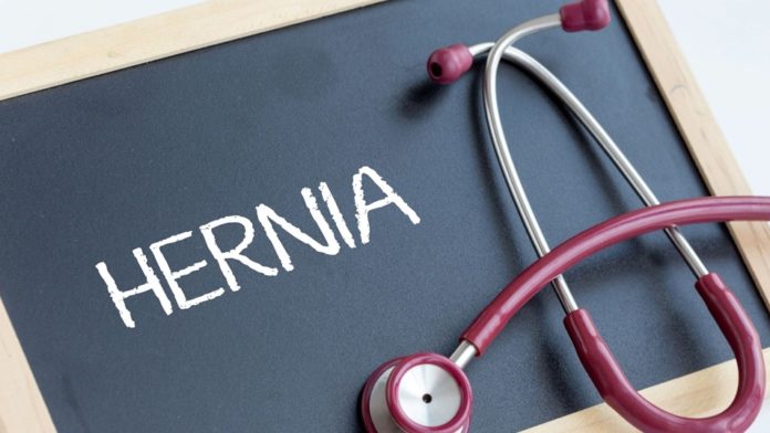 Know Regarding Hiatal Hernia