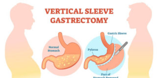 Sleeve Gastrectomy Bariatric