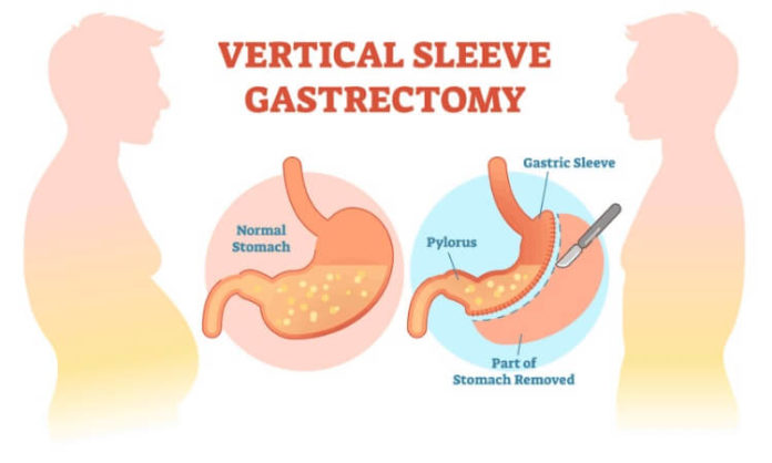 Sleeve Gastrectomy Bariatric