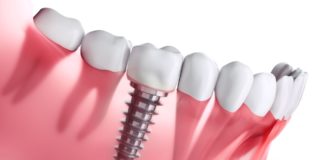 Getting Dental Implants