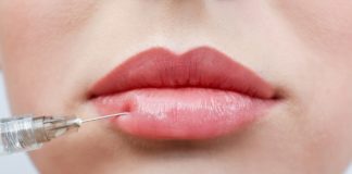 Lip Fillers